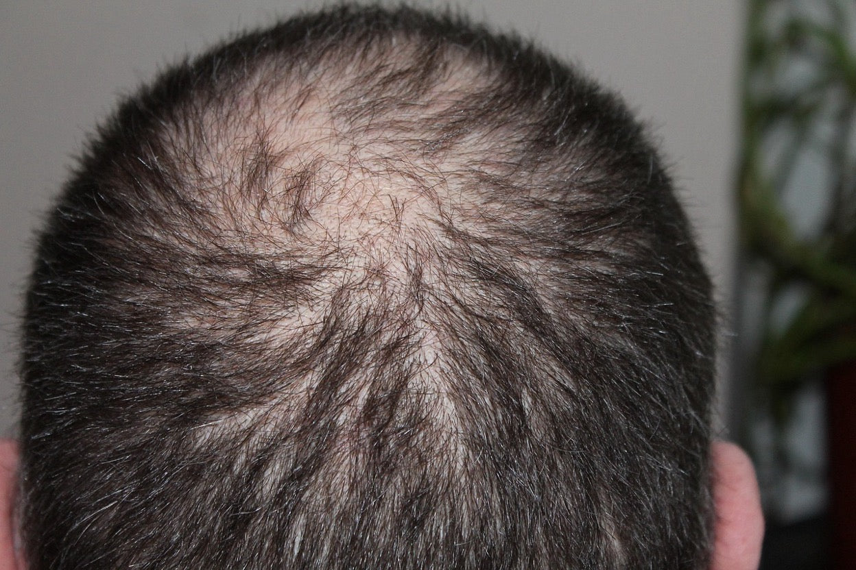 Androgenic Alopecia vs PCOS Hair Loss: Differences, Treatments & Success Stories