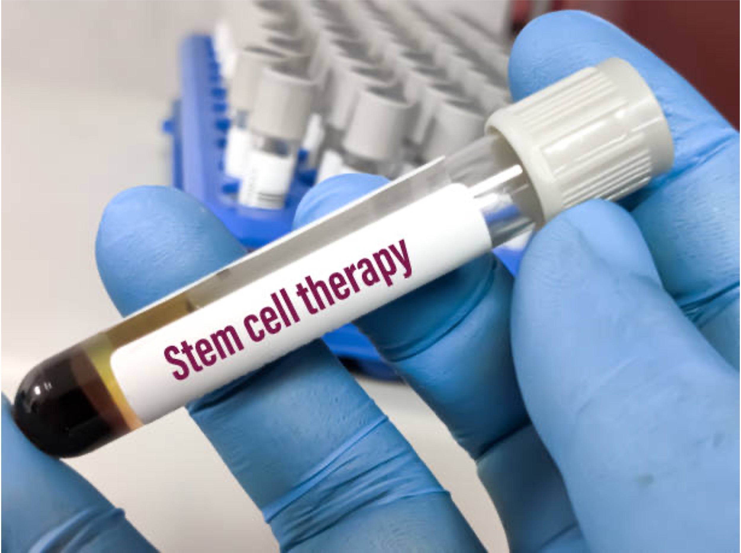 Stem Cell Therapy for Hair Loss: Results, Cost & Side Effects
