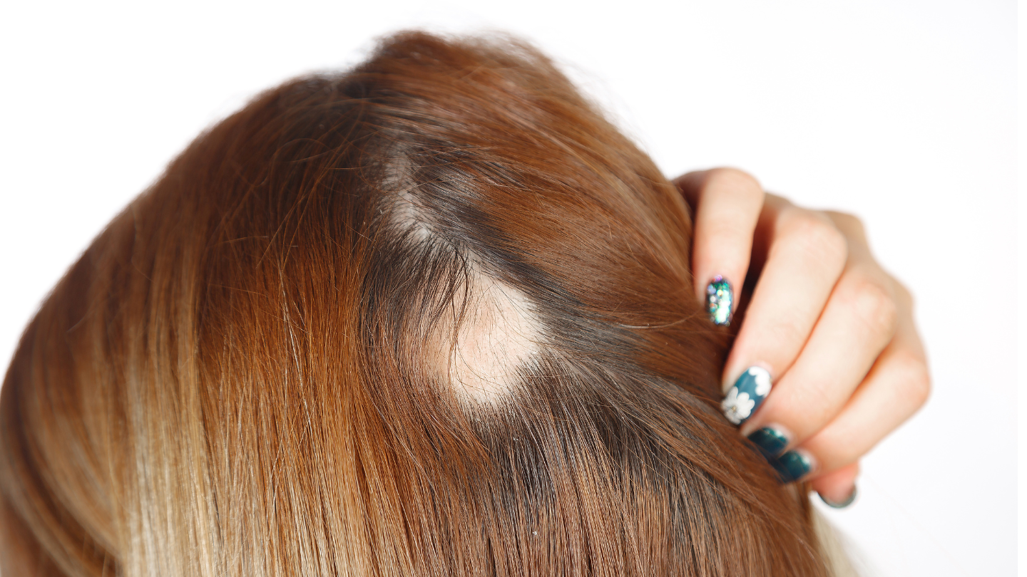Traction Alopecia