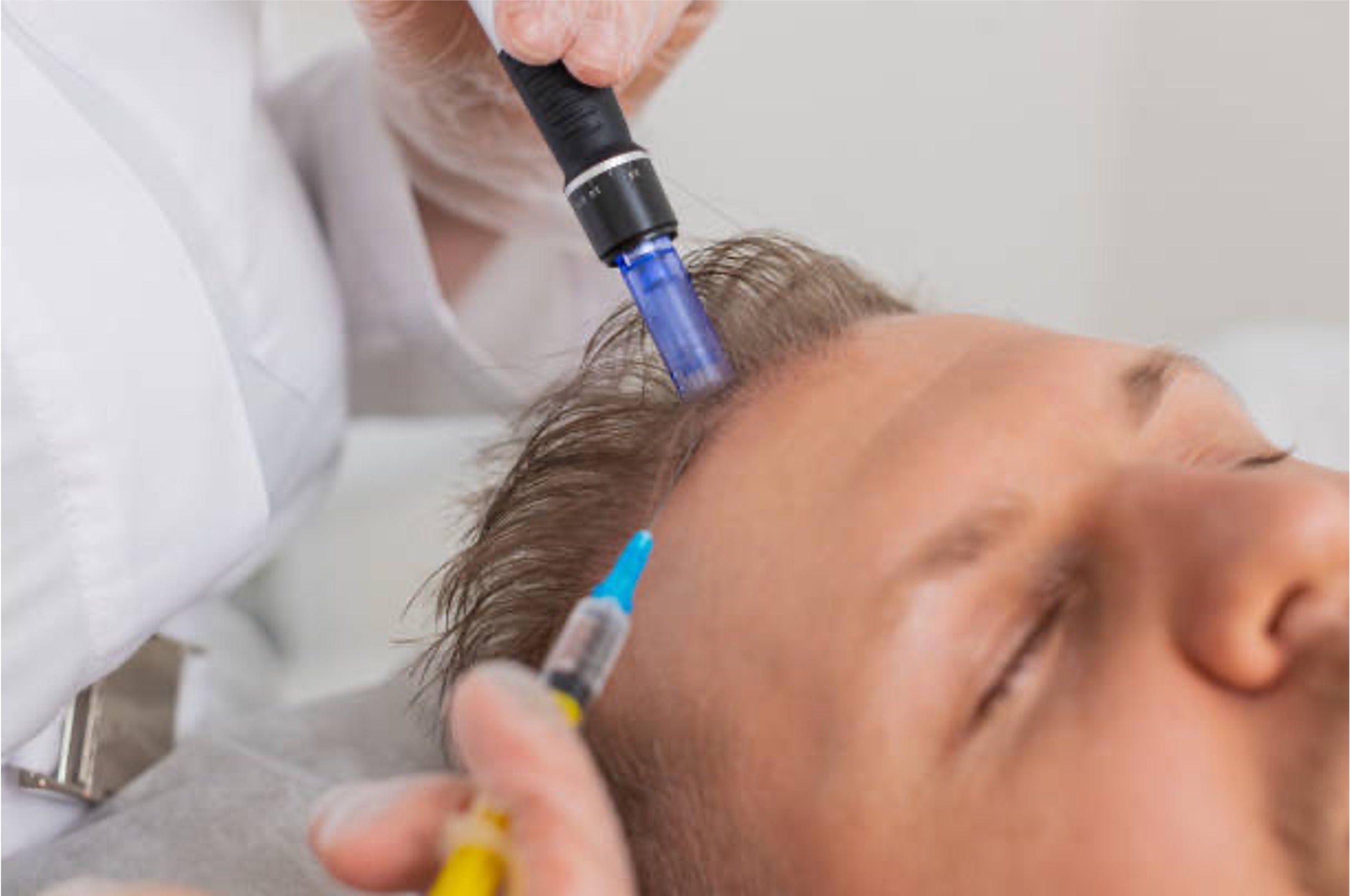 Exosome Therapy for Hair Loss: Results, Cost & Side Effects