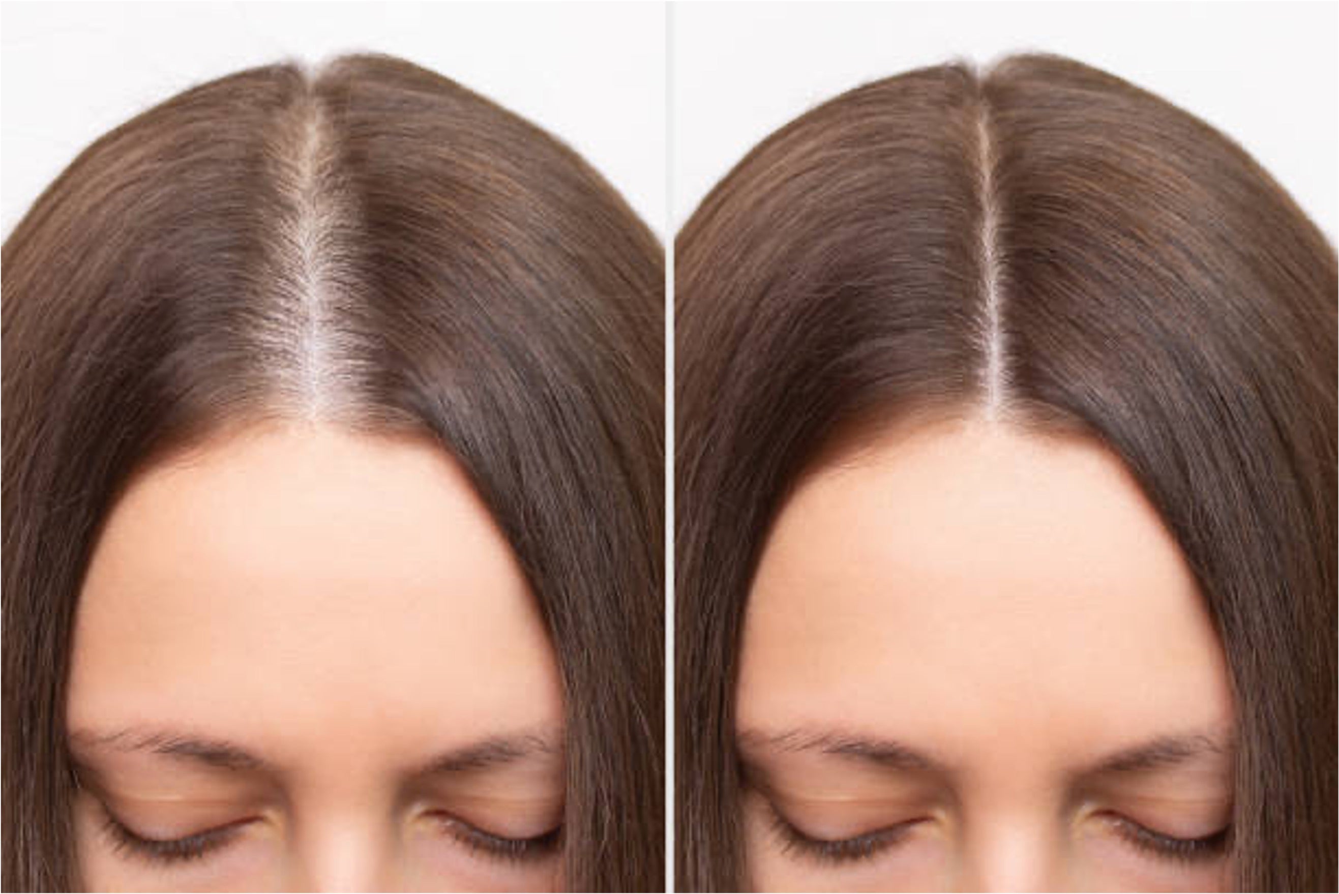 Thinning Hair vs Normal Hair Parting: Differences & Signs to Look For ...
